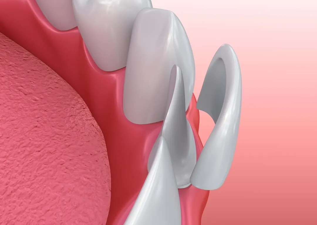 Porcelain Veneers