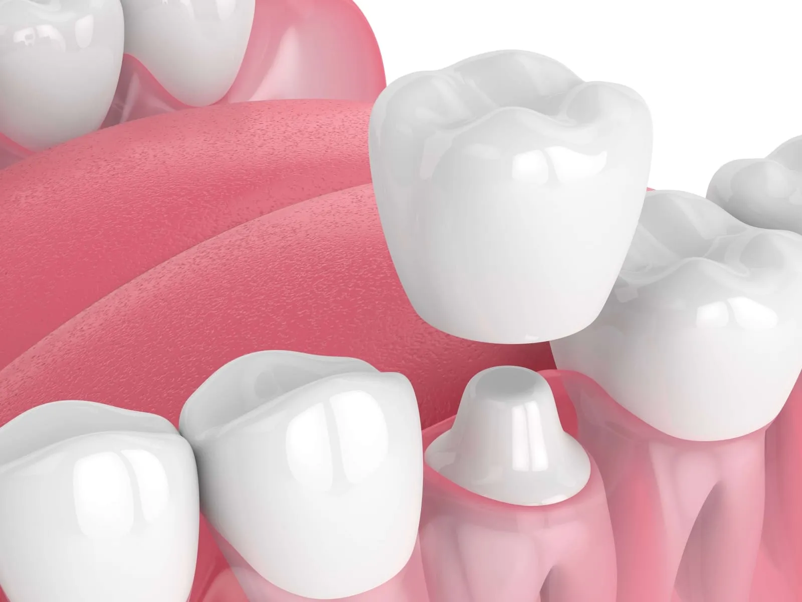 dentist-sheboygan-crowns-02