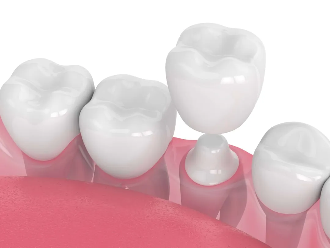 dentist-sheboygan-crowns-03